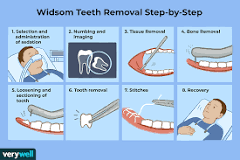 Wisdom teeth removal