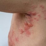 Decoding About The Disease: What does Shingles look like?